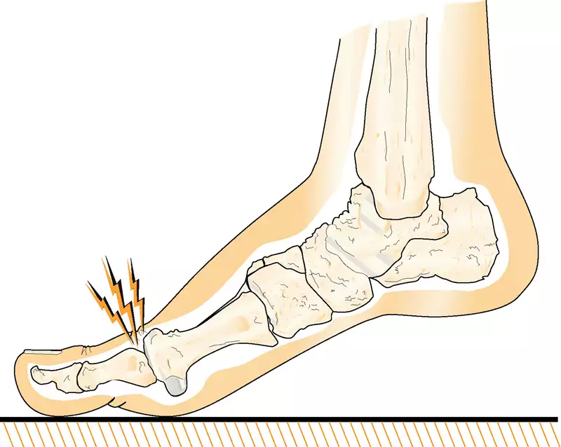 Hallux rigidus