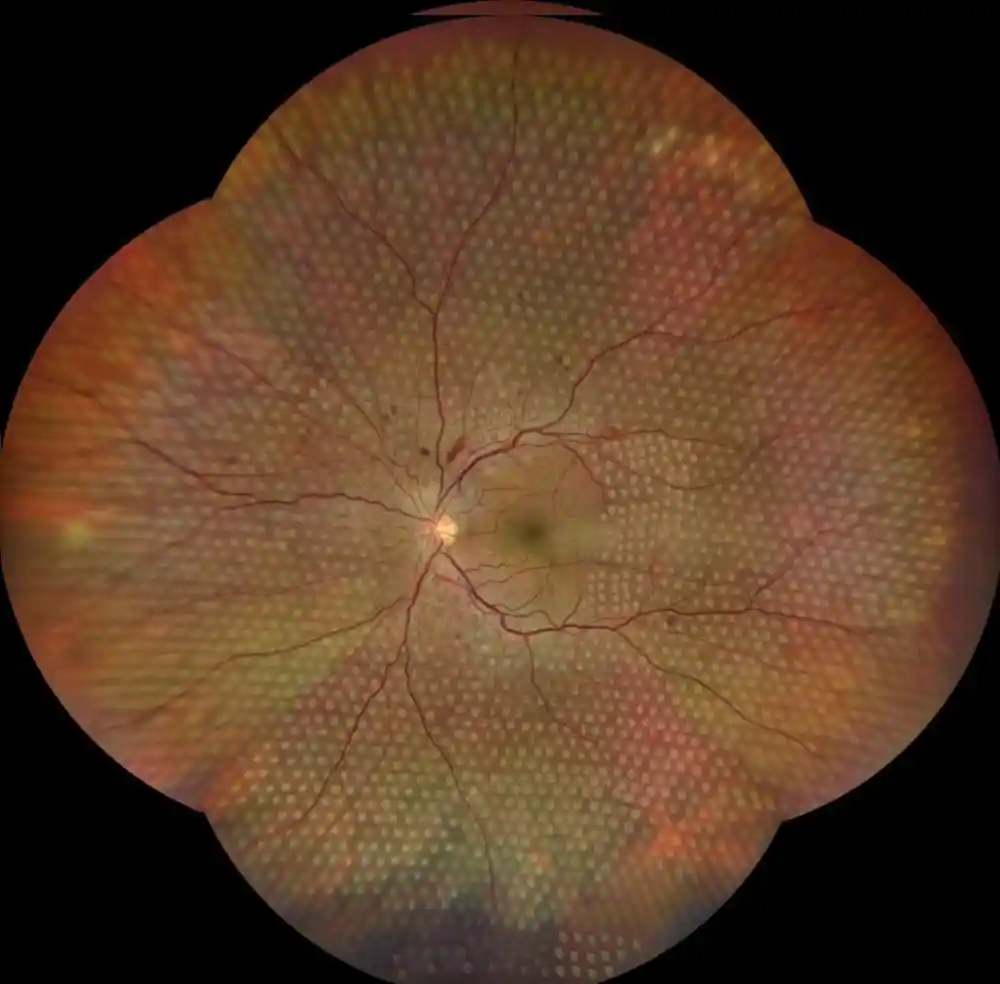 Bilden visar ett fotomontage på en nybehandlad näthinna som har behandlats i alla kvadranter med retinal laser.
