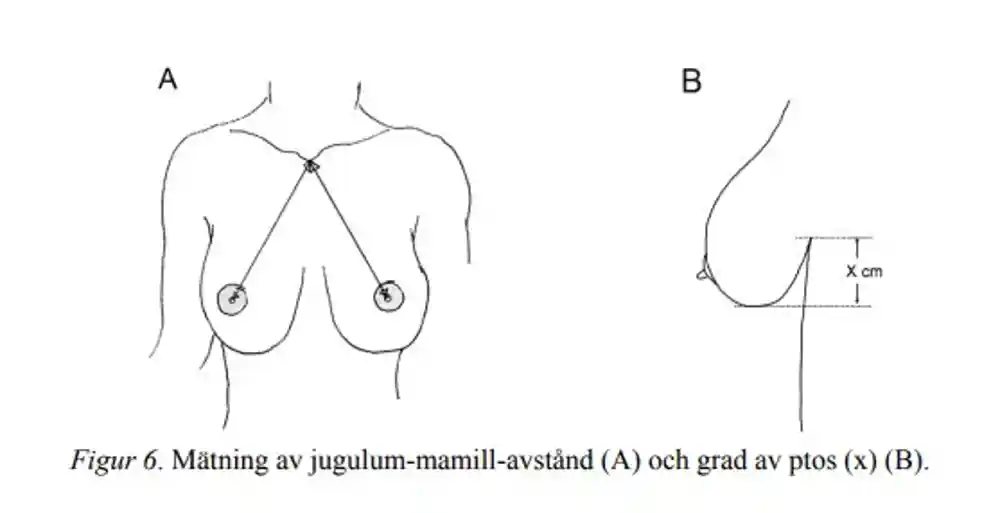 Mätning av jugulum–mamillavstånd (A) och grad av ptos (B). (Figur 6 från NMI 2018)