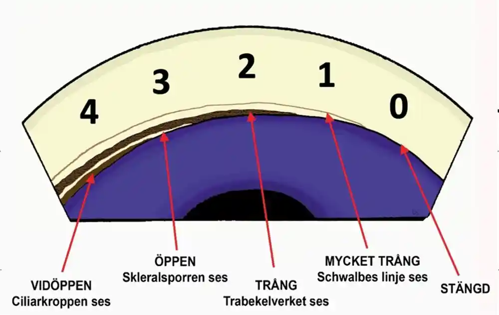 Bild som visar öppningsgradering enligt Schaffer av kammarvinkel