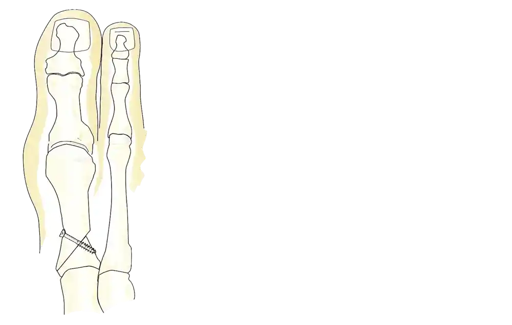 Illustration av två benformade strukturer i beige och gulaktiga nyanser, med stiliserade anatomiska detaljer. På det nedre området av det ena benet syns en kirurgisk skruv som är placerad diagonalt.