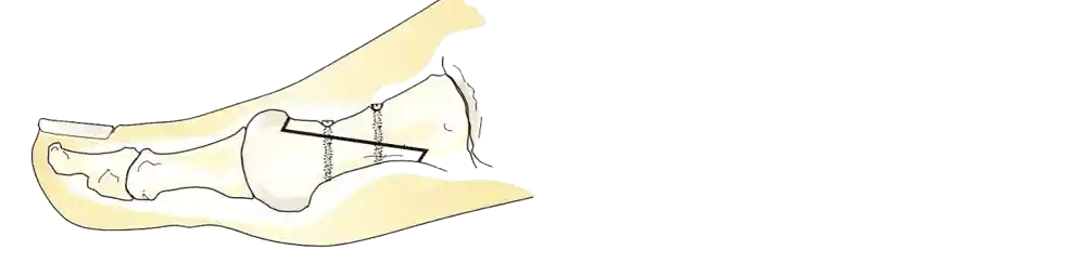 Illustration av ett tvärsnitt av en fot som visar skelettets benstruktur i färgerna gul, beige och vit. Bilden fokuserar på stortåns tredje led där två kirurgiska skruvar är placerade genom ett diagonalt svart streck.