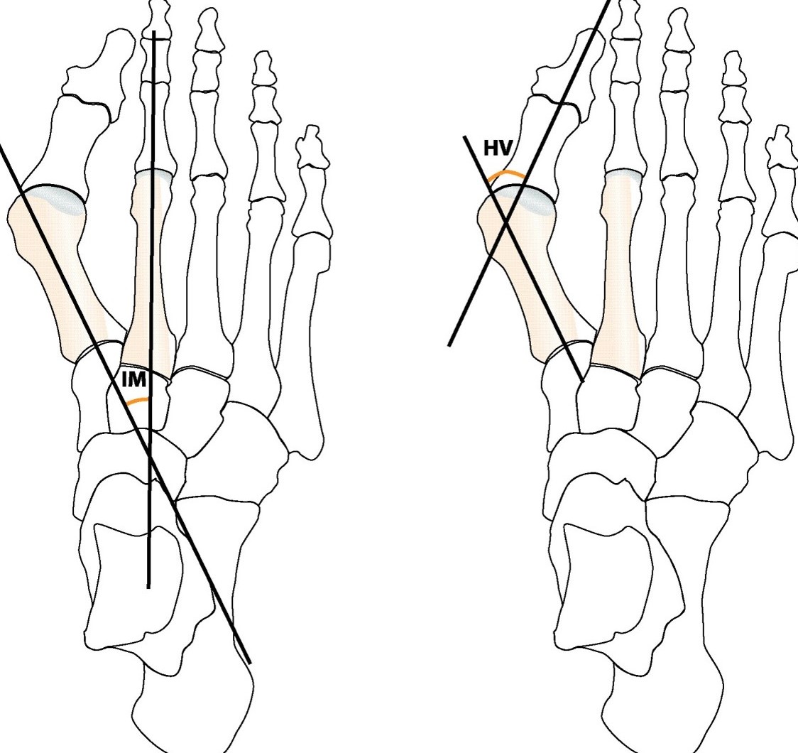 Illustration av två skelettfötter som visar skillnader i vinklar relaterade till hallux valgus. Den vänstra foten visar en normal position av stortåns ben med en rak linje som löper genom metatarsalbenet. Den högra foten illustrerar en avvikande vinkel (markerad med HV) där stortån böjer sig mot de andra tårna.