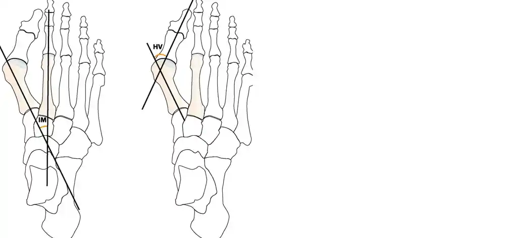 Illustration av två skelettfötter som visar skillnader i vinklar relaterade till hallux valgus. Den vänstra foten visar en normal position av stortåns ben med en rak linje som löper genom metatarsalbenet. Den högra foten illustrerar en avvikande vinkel (markerad med HV) där stortån böjer sig mot de andra tårna.