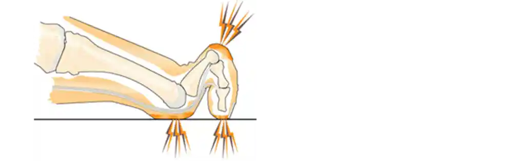 Bildbeskrivning av klotå med en illustration av en tå med skelettet synlig och det skjuter blixtar från de tre ställena där den krökta tån böjer sig.